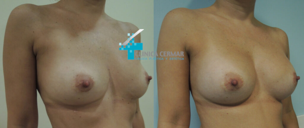 antes despues explanacion mamas 2