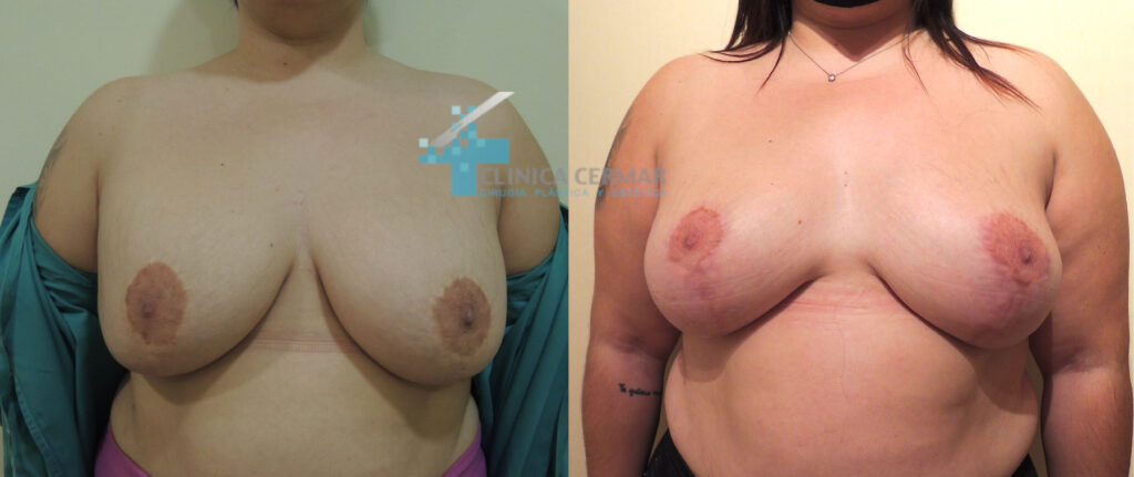 antes despues explanacion mamas 4